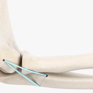 SISTEMA FIJACION FLEXIBLE 4