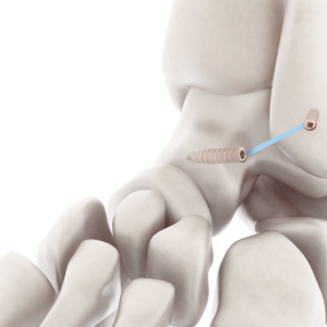 SISTEMA FIJACION FLEXIBLE 5